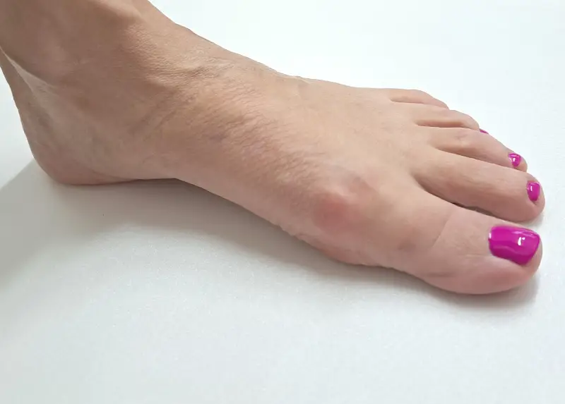 Hammer toes after surgery